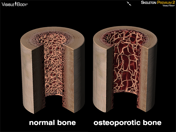 Osteoporotic bone osteoporosis bone damage brittle bones compact bone